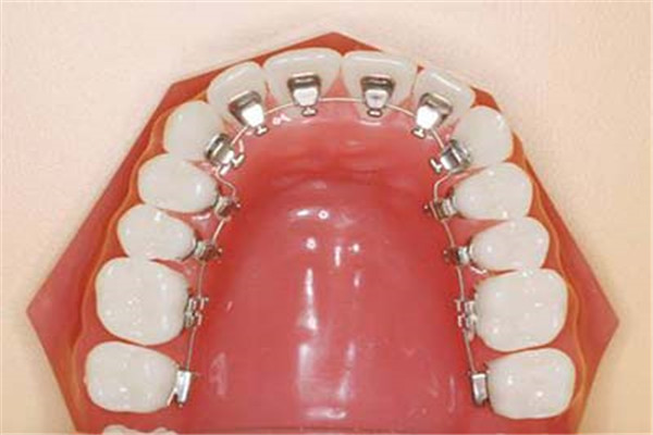 尼勒克好的牙齒矯正類型醫院