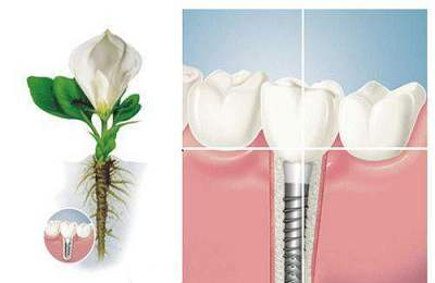 種植牙流程