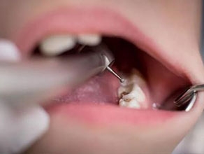 兒童齲齒治療